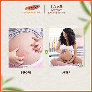 Dầu giảm nhanh khô ngứa da khi mang thai Palmer's 150ml