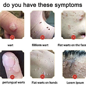 Serum Xóa Mụn Cóc, Mụn Thịt, Nốt Ruồi Hiệu Quả Cao – Thảo Dược Thiên Nhiên, Không Gây Sẹo đèn led