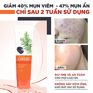 Sữa Rửa Mặt Tạo Bọt Ngừa Mụn Oriss 100g - Chuyên Dành Cho Da Mụn