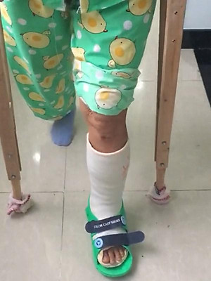 Giày bảo vệ chân BL Tech size M (Xanh lá cây) dùng cho chân đang chấn thương hoặc bó bột