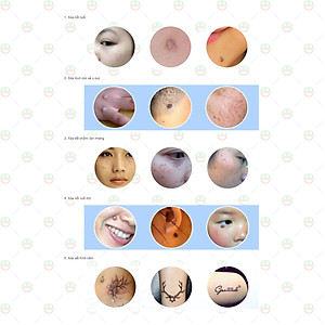 [Đẹp Tự Nhiên] Bút Xóa Đốt Nút Ruồi KhoNCC Hàng Chính Hãng - Tàn Nhang - Mụn Cóc - Thịt Dư - Có Đèn Led Hiển Thị Tự Làm Đẹp Hiệu Quả Một Cách Bất Ngờ - KLVQ-324-BXTN