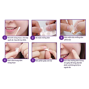 Combo 5 Miếng Dán hỗ trợ điều trị Mụn Mayancare 12 Miếng (1.0cm)