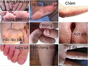 Kem Bôi Nứt Nẻ Á Sừng Tay Chân Ngoài Da - Hàng Nhập Khẩu