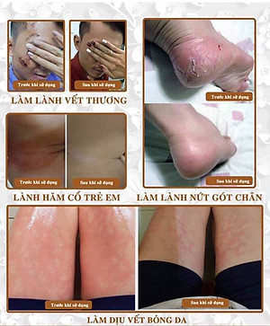 Mỡ Trăn N'store Nguyên Chất Triệt Lông Vĩnh Viễn, Giảm Bỏng Da, Dưỡng Da, Ngăn Ngừa Rạn Nứt Da (1 Chai 100ML)