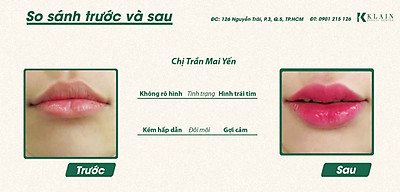 Top 8 các kiểu dáng môi đẹp cuốn hút nhất thế giới