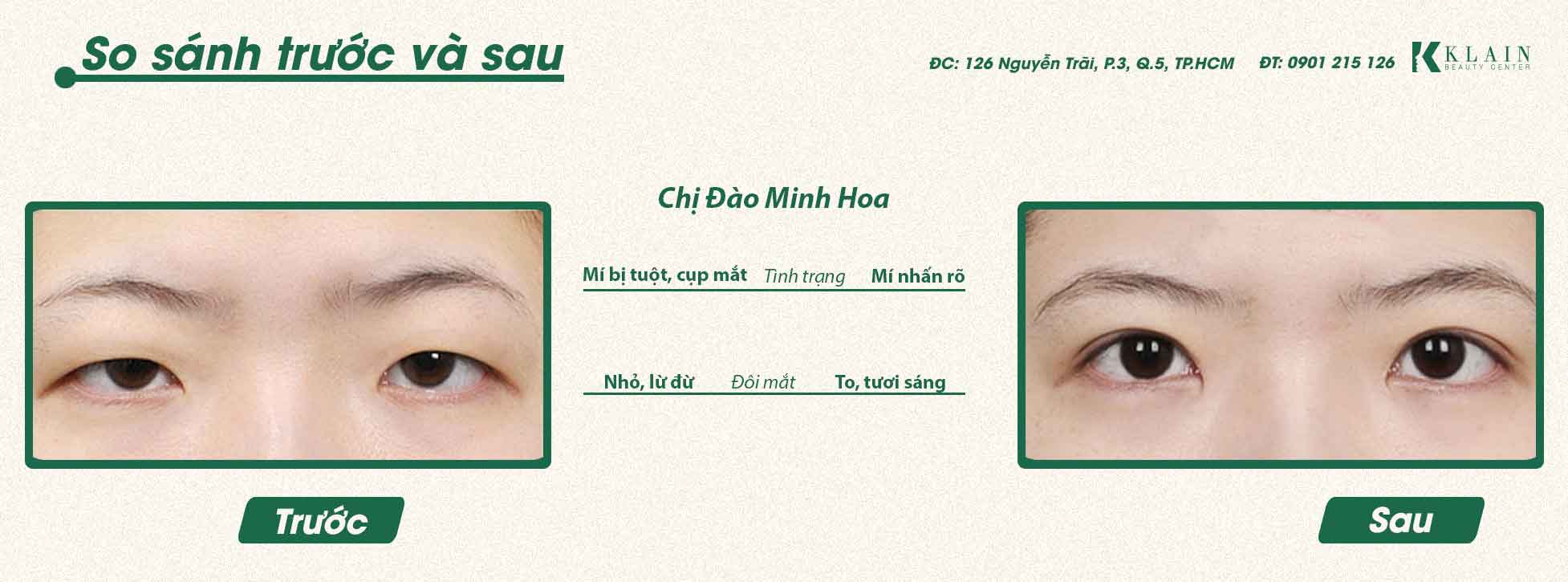 SỞ HỮU ĐÔI MẮT CHUẨN ƯA NHÌN | KLAIN BEAUTY CENTER - BÁC SĨ KHẢI