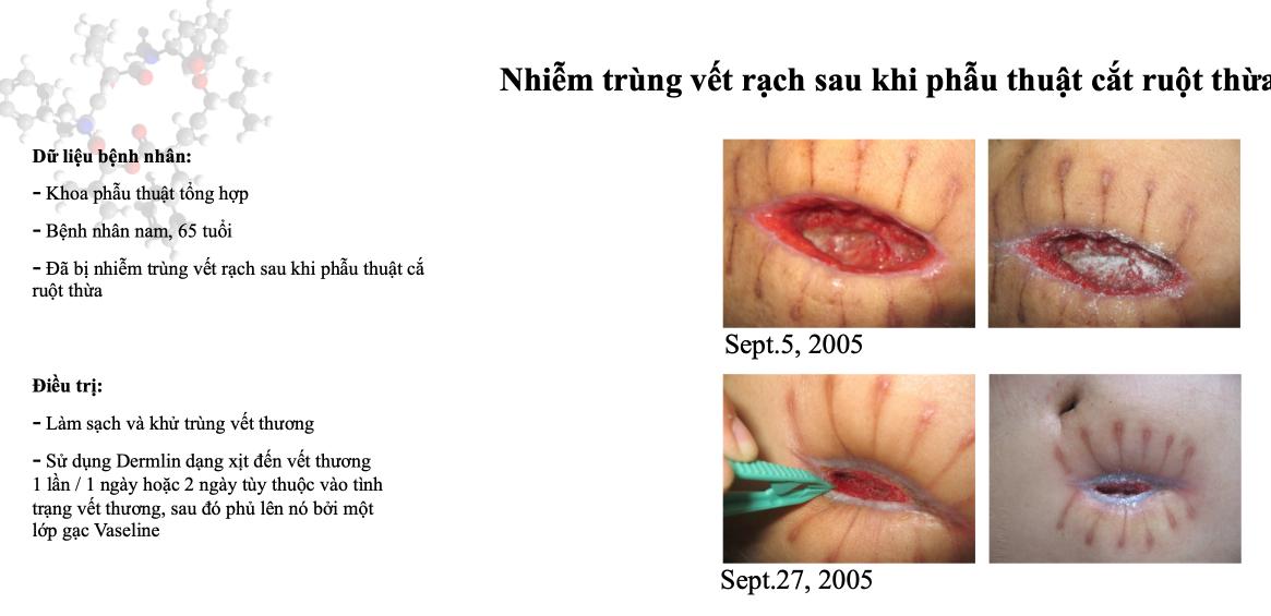 Dermlin Bột Nano Sinh Học Công Nghệ Boston Liền Nhanh Vết Thương Cấp và Mãn Tính,  Loét Bệnh Lý Thẩm Mỹ Tránh Sẹo