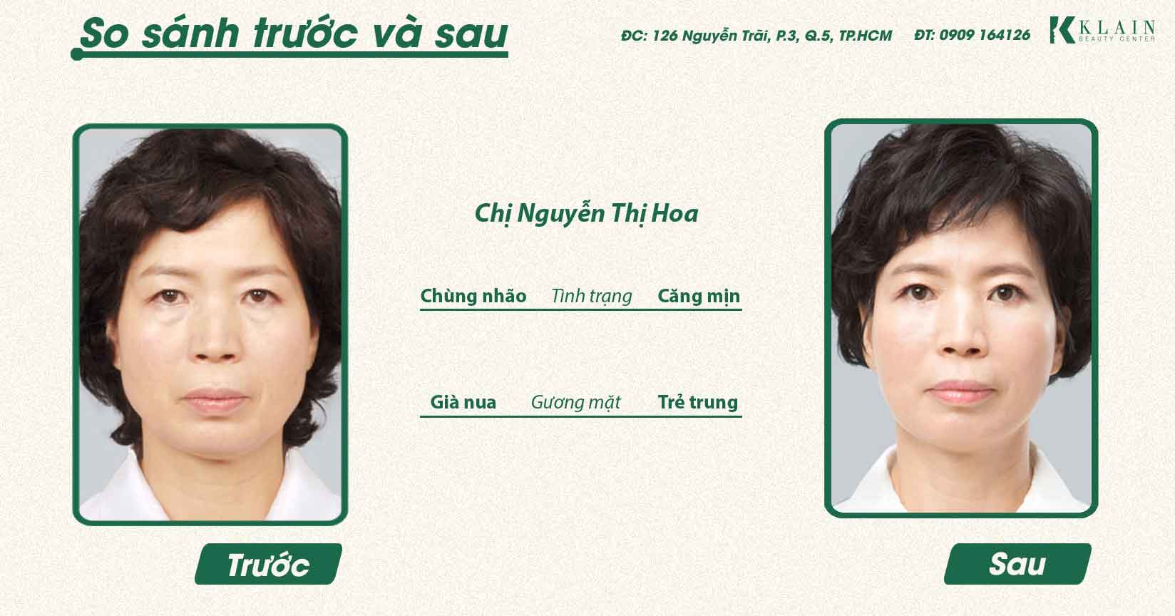 CĂNG DA TRẺ HÓA | KLAIN BEAUTY CENTER - BÁC SĨ KHẢI