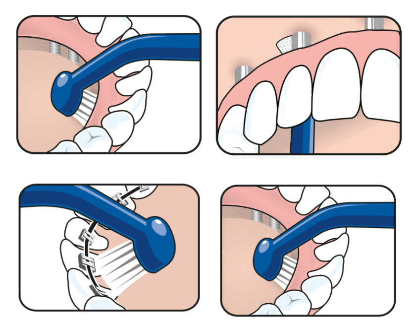 Bàn chải đánh răng đầu vòm dùng cho răng implant Tepe Implant Care nhiều màu