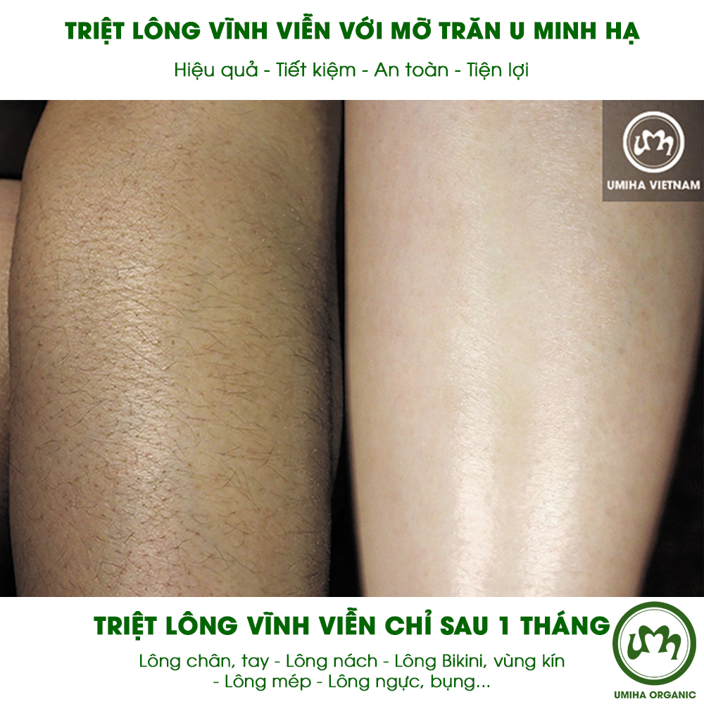 COMBO TẨY TRIỆT LÔNG CHÂN TAY VĨNH VIỄN UMISKIN tại nhà | Mỡ trăn triệt lông vĩnh viễn U Minh Hạ (30ml) &amp; Kem tẩy lông Umi 4C (100ml) an toàn cho da nhạy cảm