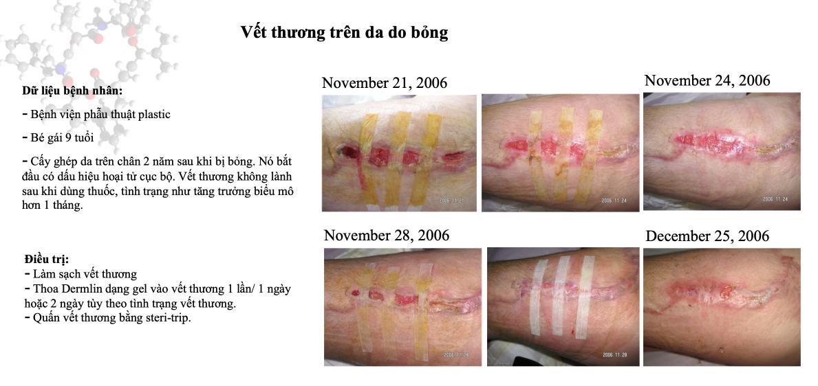 Dermlin Bột Nano Sinh Học Công Nghệ Boston Liền Nhanh Vết Thương Cấp và Mãn Tính,  Loét Bệnh Lý Thẩm Mỹ Tránh Sẹo