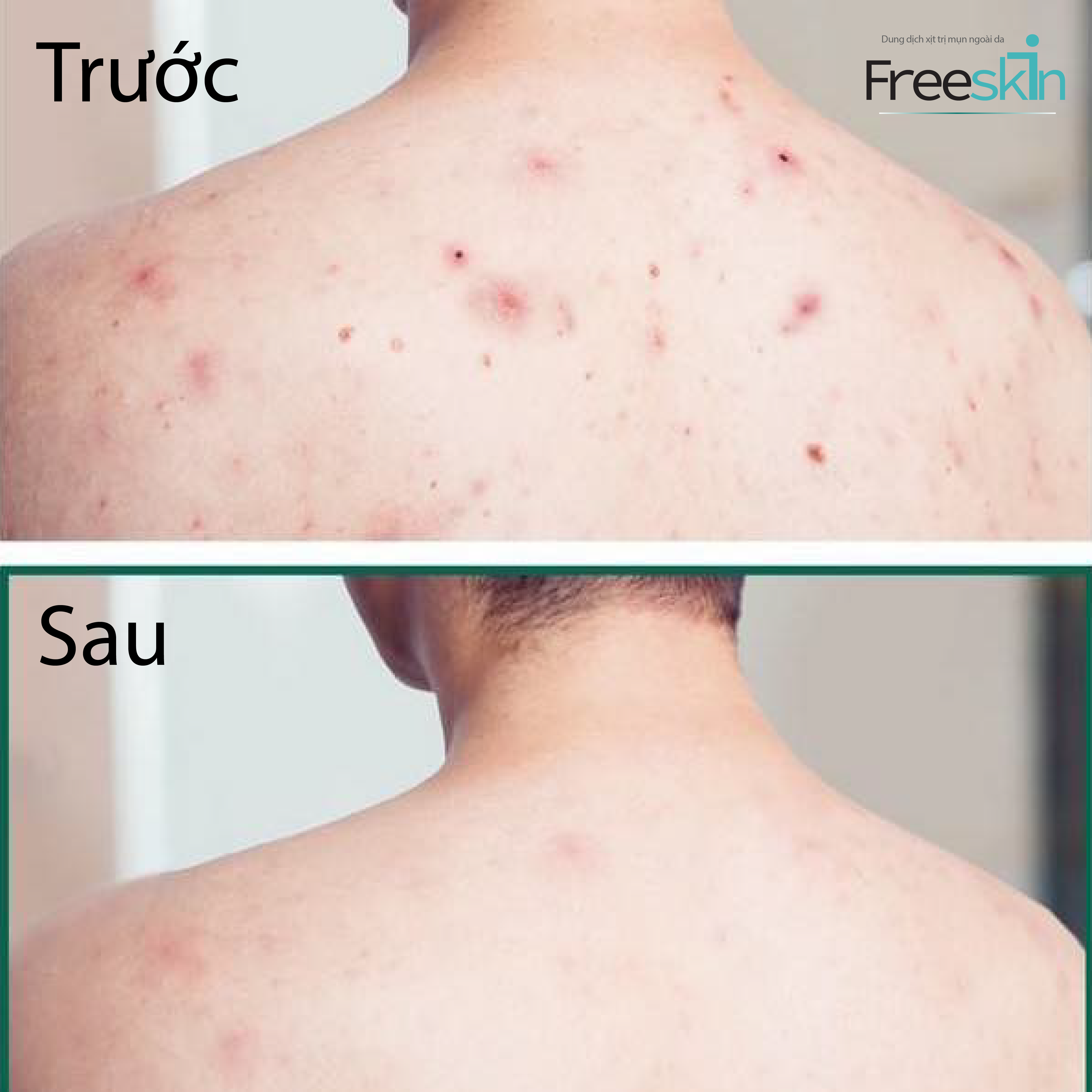 Xịt hỗ trợ Trị Mụn Lưng, Mụn Cơ Thể - Freeskin - Giúp Sạch Mụn, Hết Thâm, Làm Mềm Da, Sáng Da (80ml)