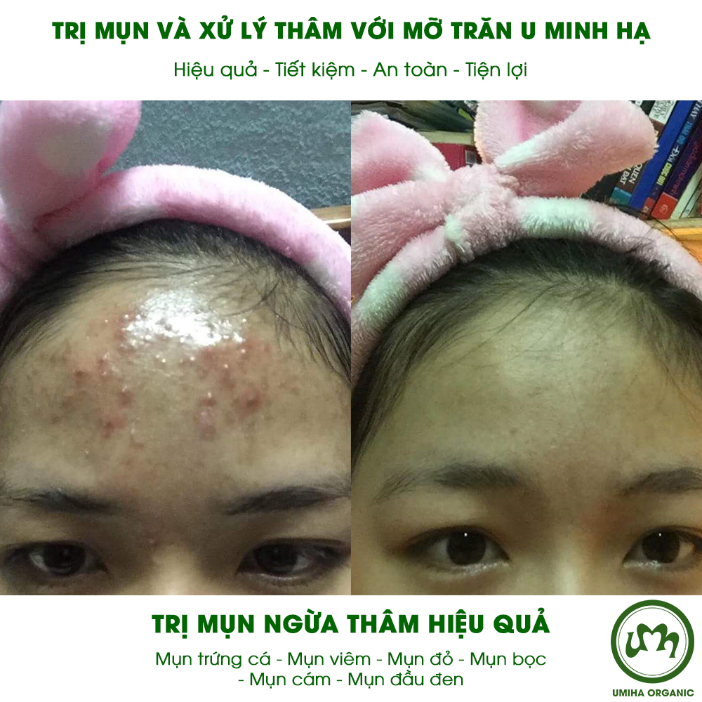 MỠ TRĂN NGỪA MỤN NGỪA THÂM U MINH HẠ hiệu quả cho mụn cám, đầu đen, mụn thâm, mụn bọc, mụn đỏ, mụn trứng cá