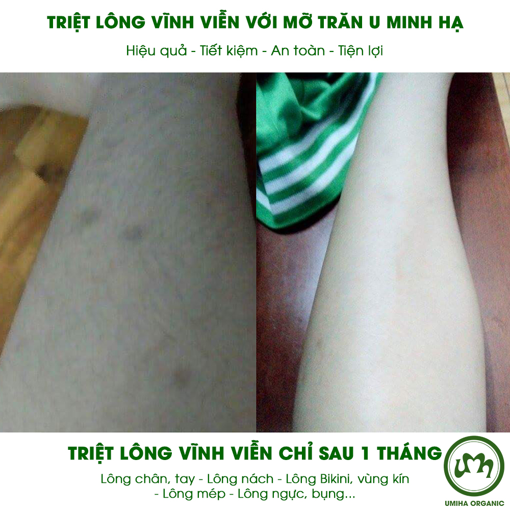 Combo tẩy triệt lông Bikini vĩnh viễn UMIHA tại nhà | Mỡ trăn triệt lông vĩnh viễn U Minh Hạ (30ml) &amp; Kem tẩy lông UMIHA (85g) an toàn cho da nhạy cảm