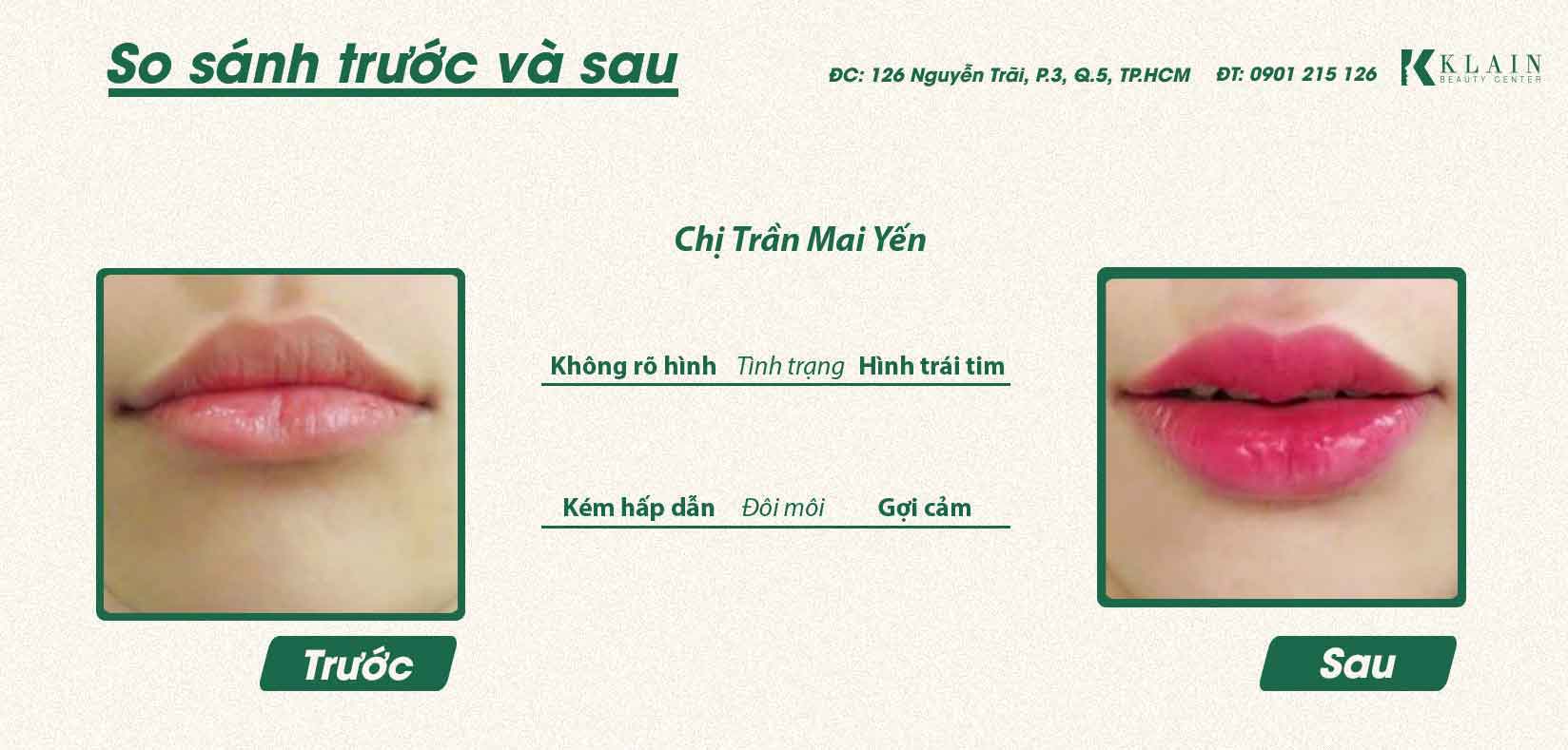 TẠO HÌNH KHUÔN MÔI | KLAIN BEAUTY CENTER - BÁC SĨ KHẢI