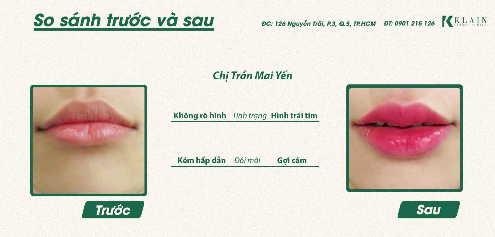 TẠO HÌNH KHUÔN MÔI | KLAIN BEAUTY CENTER - BÁC SĨ KHẢI