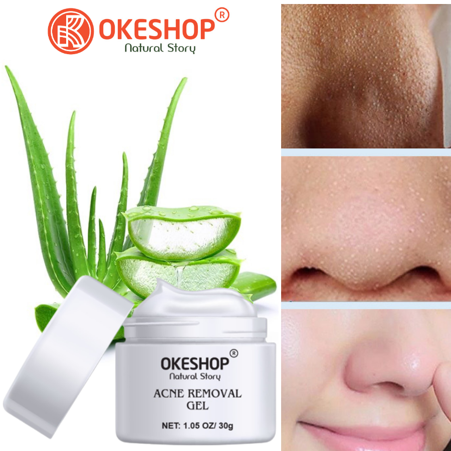 Gel Lột Mụn Nha Đam OKESHOP 30ml - Giải Pháp Loại Bỏ Mụn Đầu Đen - Mụn Cám - Bạ Nhờn - Làm Sạch Sâu Và Thu Nhỏ Lỗ Chân Lông