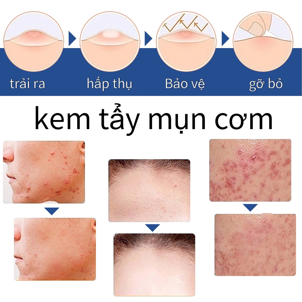 Serum bôi tẩy xóa bỏ mụn cóc mụn thịt nốt ruồi trên da hiệu quả cao từ thảo dược thiên nhiên không gây sẹo