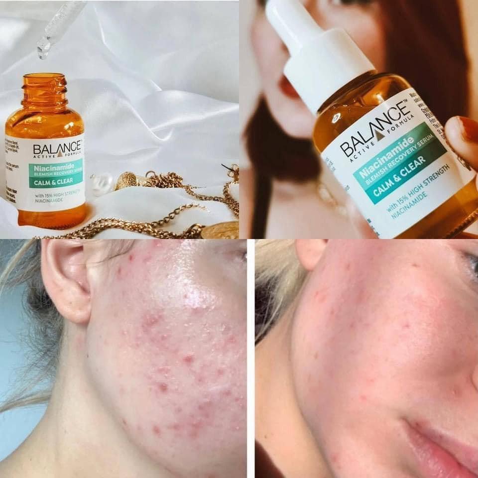 Combo 2 Serum Dưỡng Ẩm, Ngừa Mụn, Dưỡng Trắng, Mờ Thâm Balance