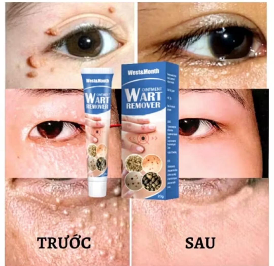 HỘP KEM TRỊ HẾT MỤN CÓC NÚT RUỒI DA NÁM SẠM