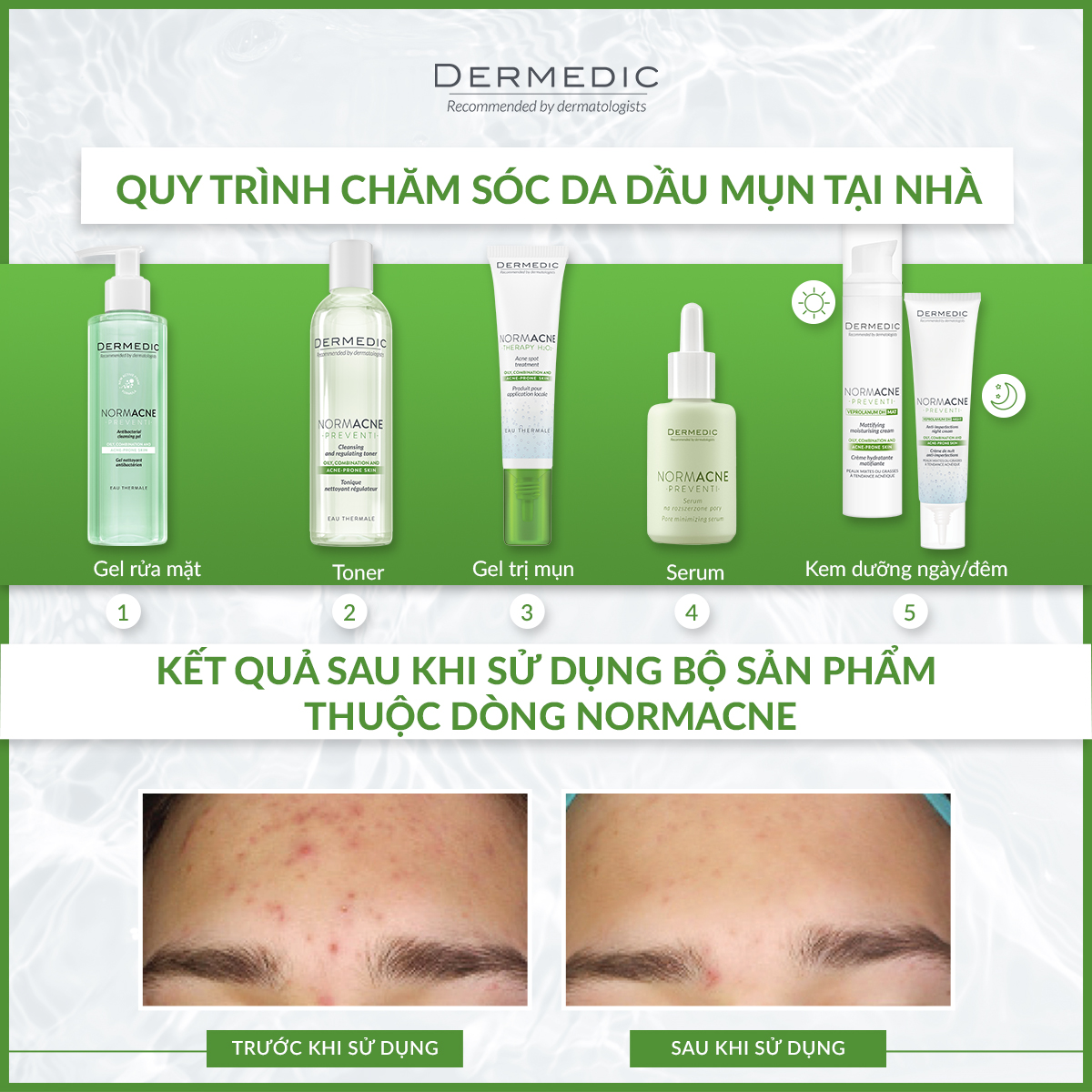 Sữa rửa mặt dạng gel hỗ trợ làm sạch dành cho da dầu da mụn Dermedic Normacne Antibacterial Cleansing Gel 500ml