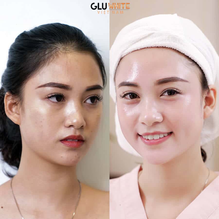 Liệu Trình 2 Hộp Viên Sủi Hỗ Trợ Làm Đẹp Da Gluwhite