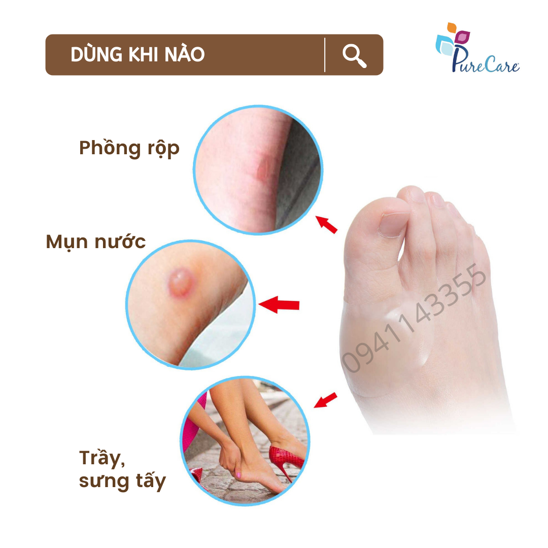 Miếng băng dán giảm mụn nước, vết chai, vết phỏng, phỏng pô, BỘ 1 CÁI