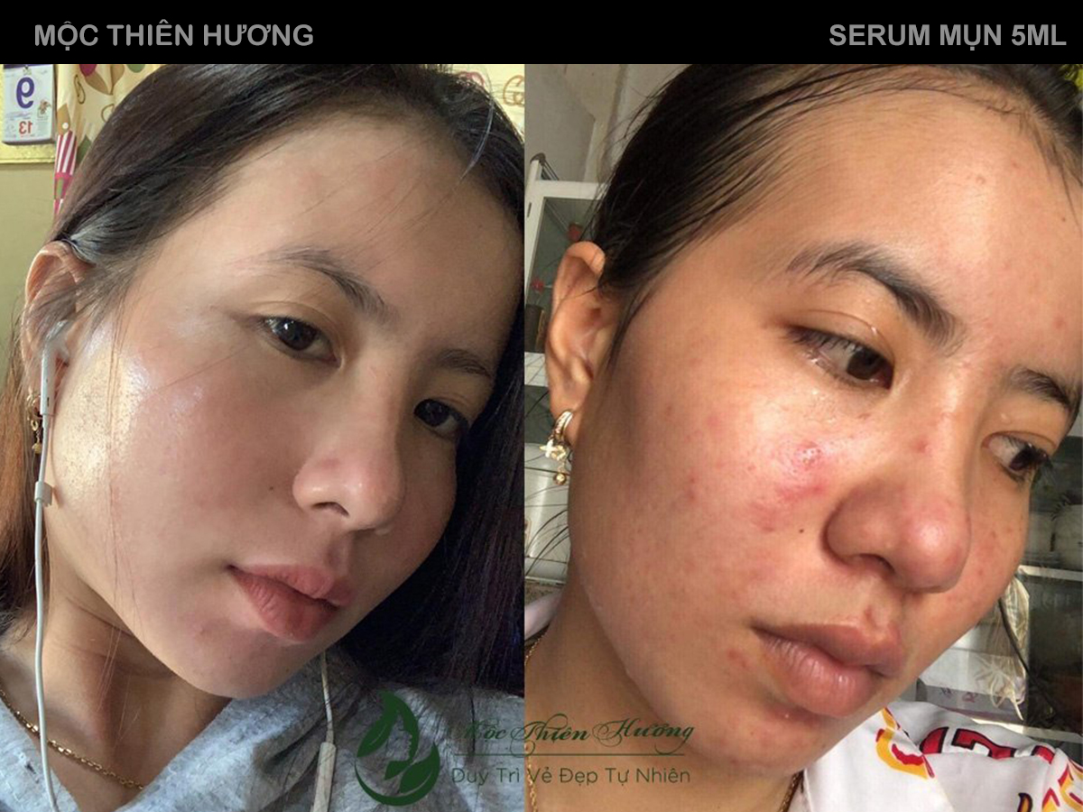 Serum 14 Ngày Hết Mụn Sạch Thâm Không Bong Tróc Không Sưng Đỏ - Mộc Thiên Hương