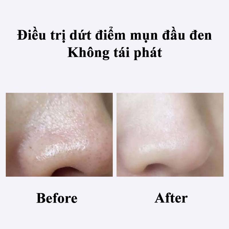 Máy Hút Mụn Đầu Đen Cầm Tay Ba Cấp Độ Hút Sạch Sâu Nang Lông Mụn Bã Nhờn Hiệu Quả Dụng Cụ Làm Sạch Lỗ Chân Lông 5 Đầu Hút Công Nghệ Nén Nóng Giúp Hút Mụn Cám Mụn Đầu Đen