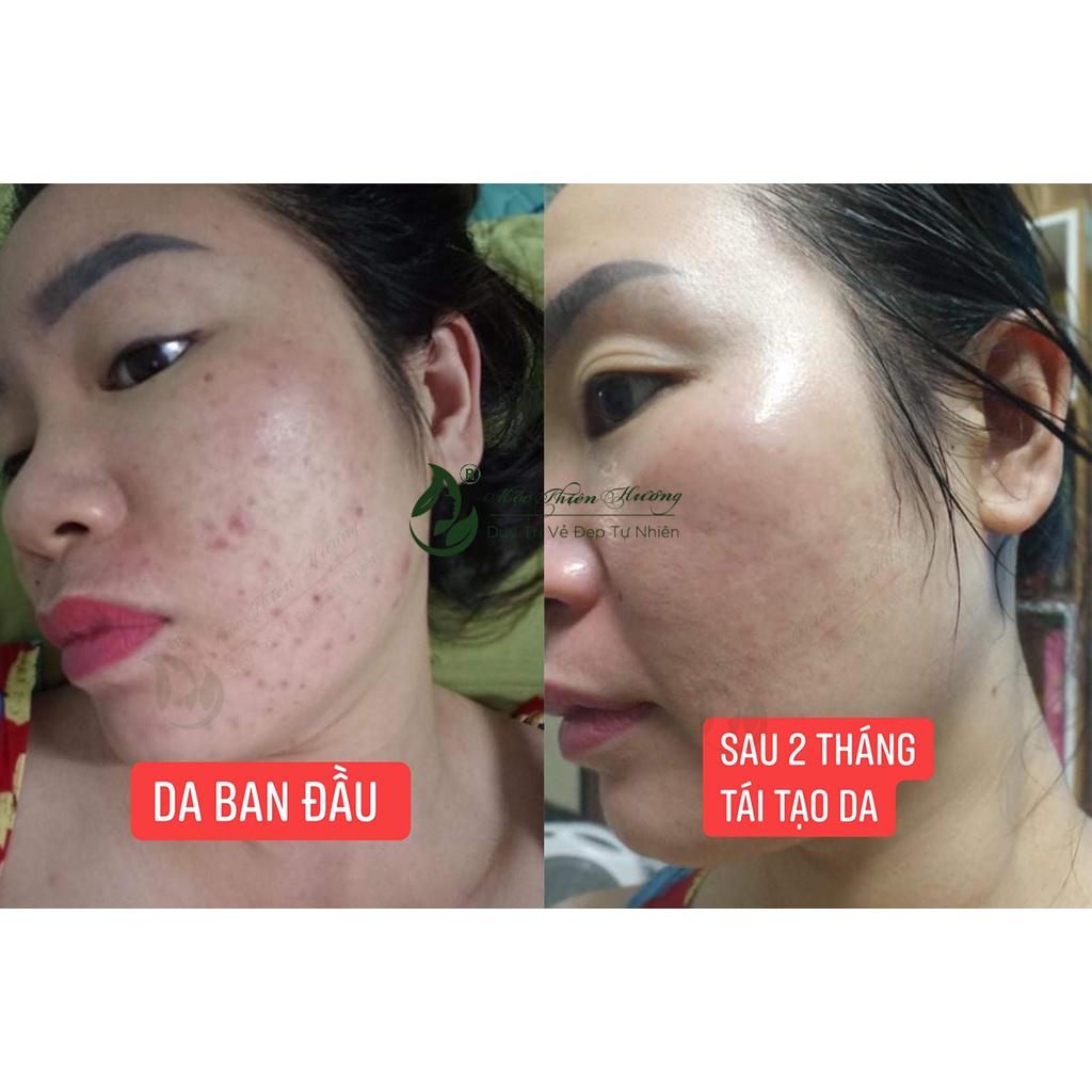 Serum Ngừa Mụn, Giảm Thâm, Dưỡng Sáng, Se Khít Da Từ Serum Thảo Mộc 50ml | Mộc Thiên Hương