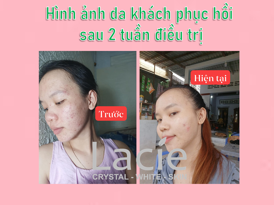 TINH CHẤT CHẤM MỤN CẤP TỐC LACIE -  ACNE TREATMENT 24H