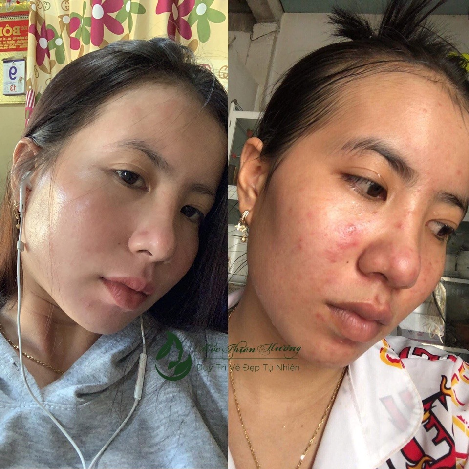 Serum 50ml Đánh Bay Mụn Thâm Nám Lâu Năm - Mộc Thiên Hương