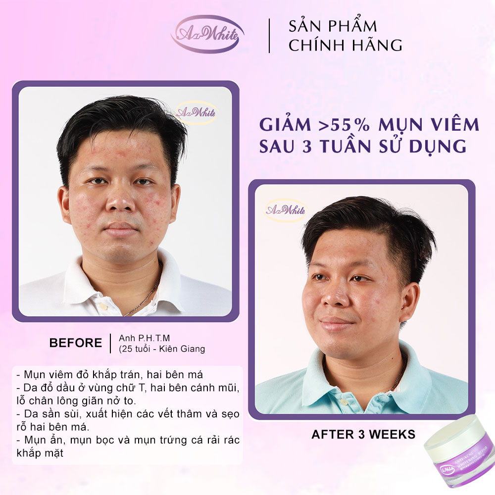 Kem Ngừa Mụn &amp; Dưỡng Trắng Da A-White 25G