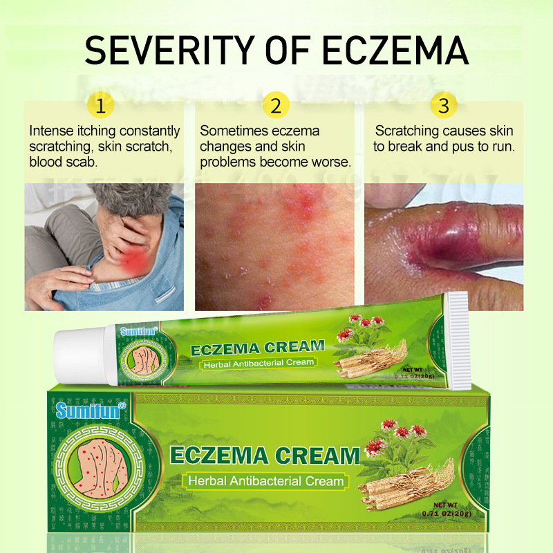 Kem bôi Eczema, chàm khô, chàm nước, ghẻ nước, thành phần thảo dược an toàn tuyệt đối