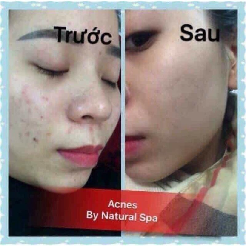 Kem Ngăn Ngừa Mụn Acne DR CELL 30g