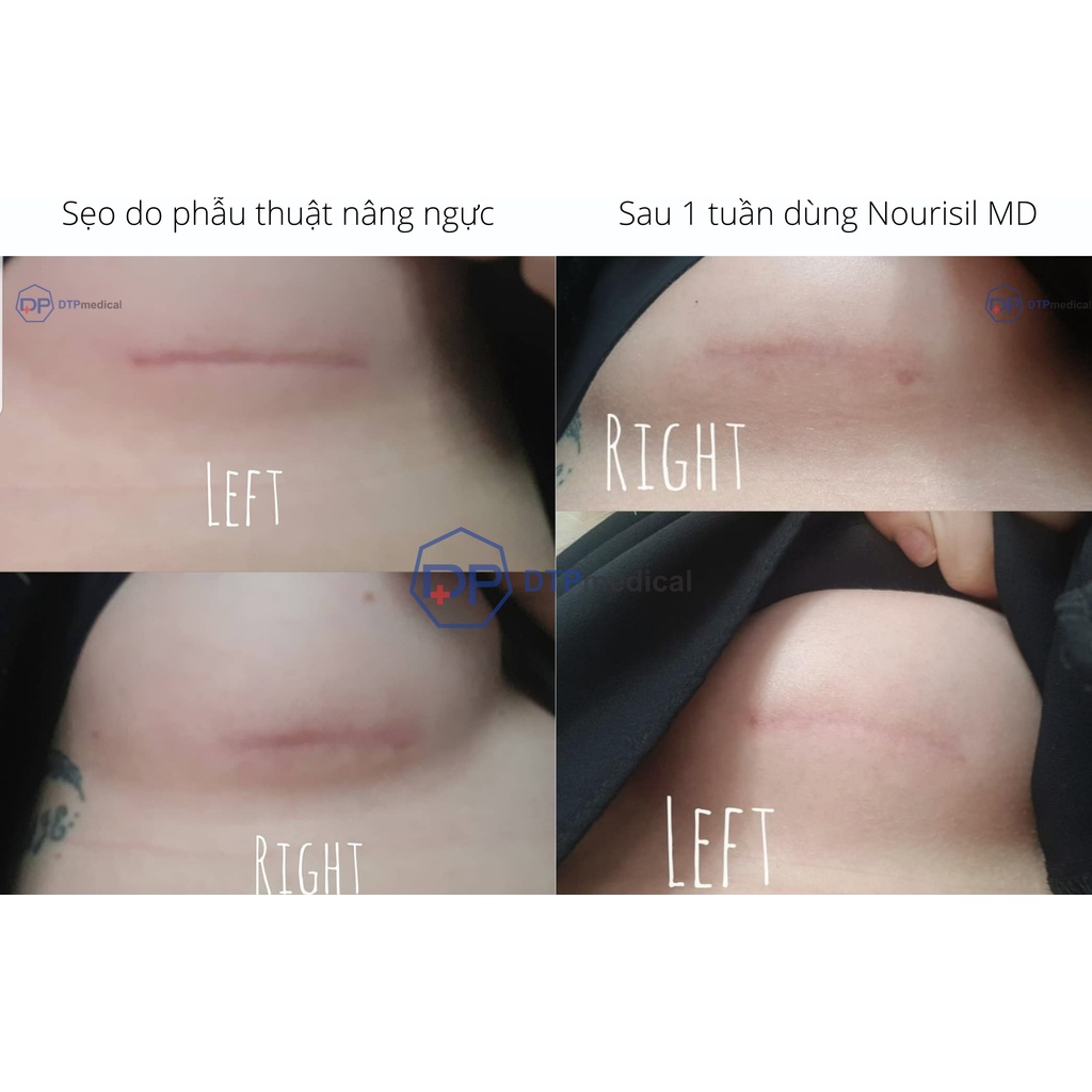 Kem sẹo Nourisil MD cao cấp - Gel sẹo silicone làm mờ và ngăn ngừa sẹo xấu hiệu quả (Chai 30g)