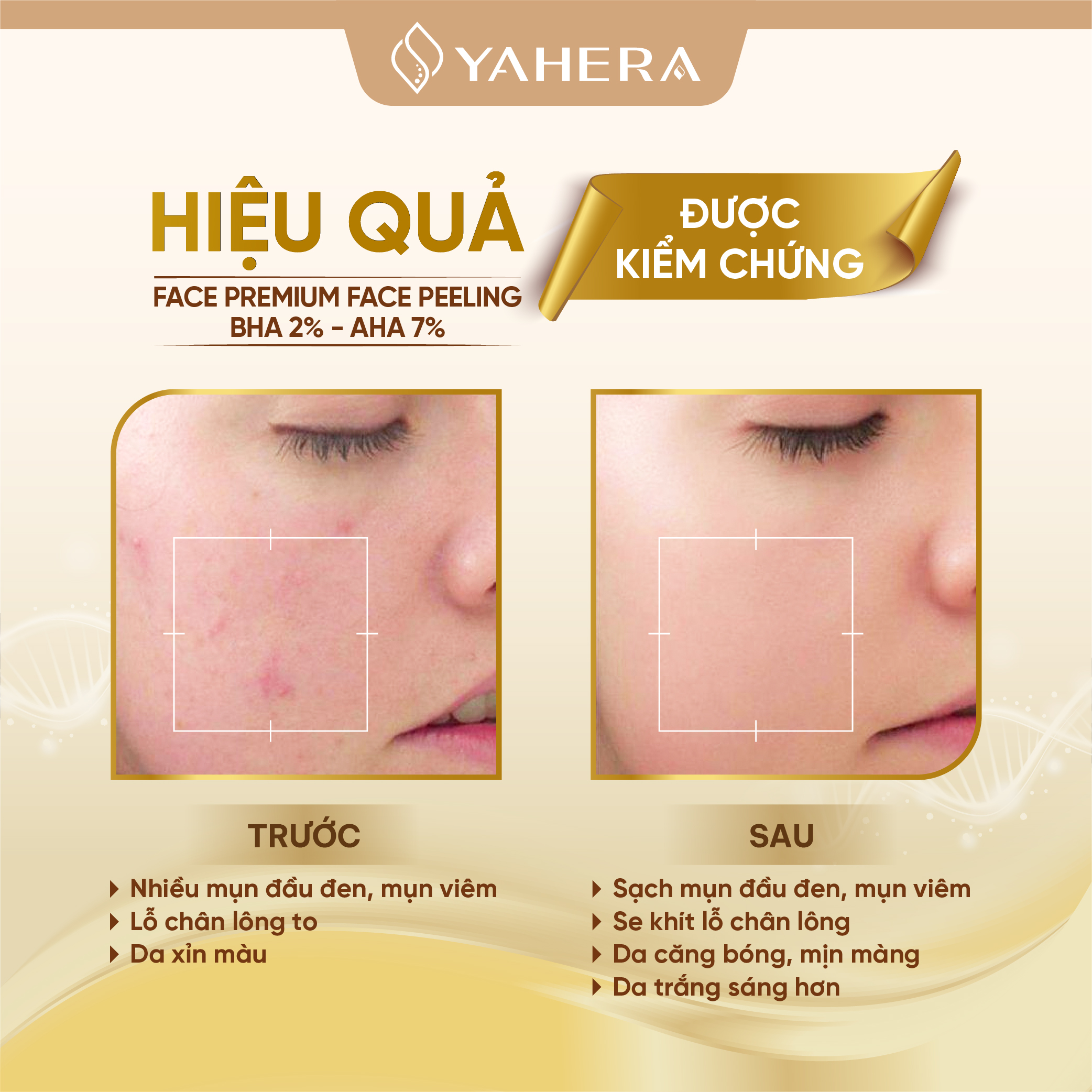 Tẩy tế bào chết hóa học cao cấp YAHERA Premium Face Peeling BHA2% AHA7% loại bỏ tế bào chết mụn đầu đen se khít lỗ chân lông 20g