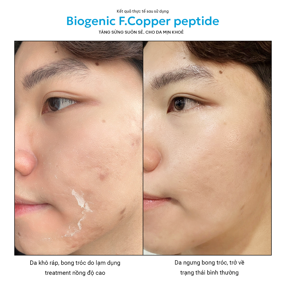 Biogenic F. Copper Peptide - Serum Phục Hồi Đa Tác Động - Giảm Kích ứng, Ngừa Oxy hóa, Sẹo Sau Mụn Twins Skin 30ml và 10ml