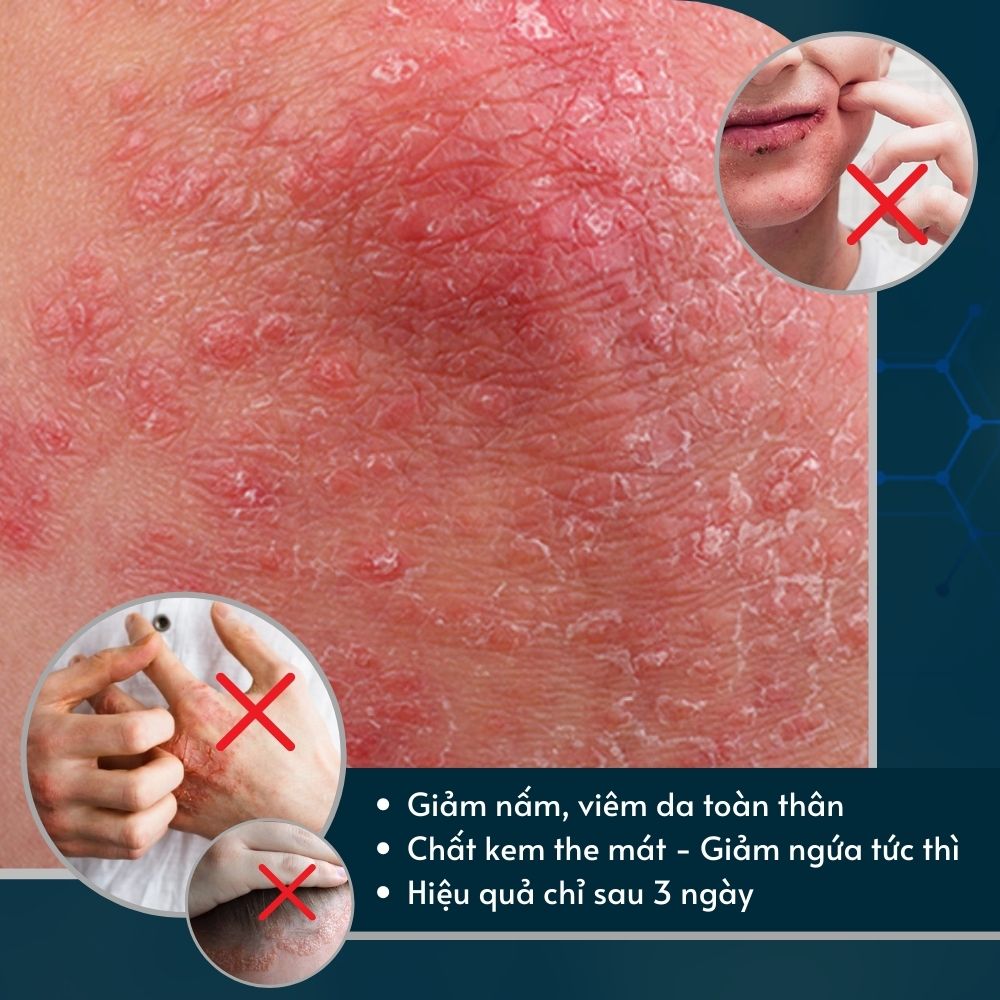 Kem bôi dứt điểm nấm da đầu, vảy nến, á sừng, eczema Dego Pharma