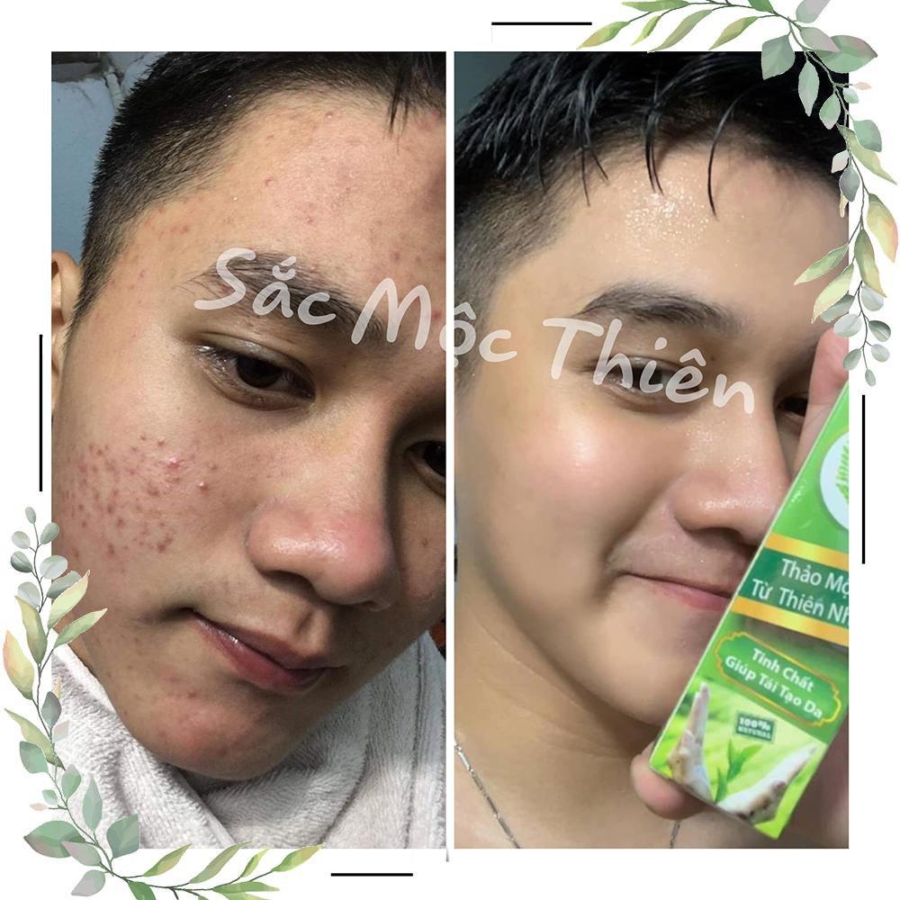 Bộ 3 Sản Phẩm Cải Thiện Mụn Siêu Tốc Sắc Mộc Thiên 30ml + 50gr + 100gr