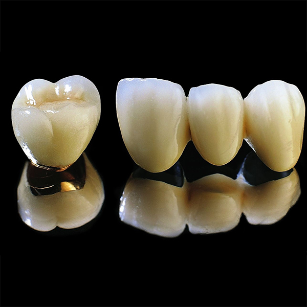Bọc 1 răng sứ Titanium tại Nha Khoa Gia Hân