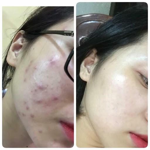 Kem mụn sưng đỏ Acne Cream IRC mụn giảm thâm, tái tạo da mới sạch khuẩn, không tái viêm 10g