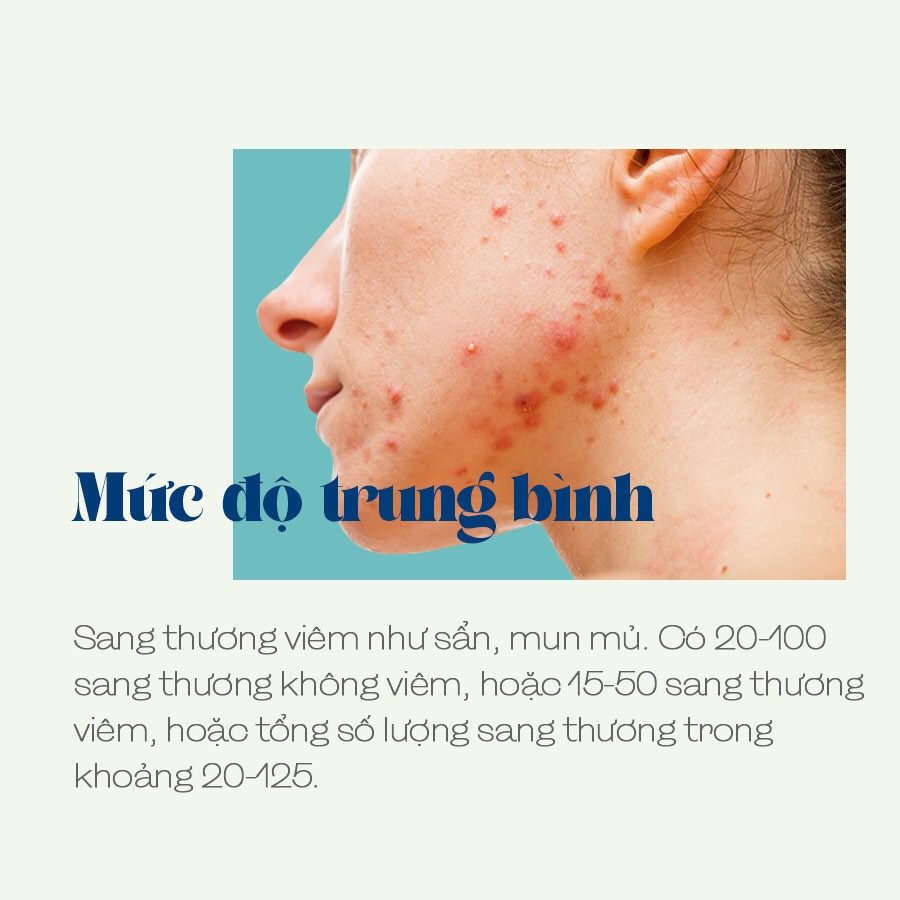 LIỆU TRÌNH CHĂM SÓC DA MỤN NẶNG NÂNG CAO