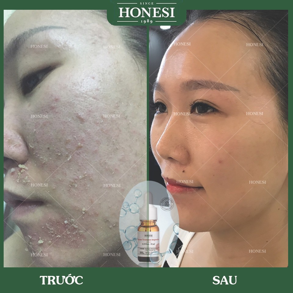 Sét Serum Giảm Mụn Nhanh Lành Tính HONESI Acne Treatment Ampoule (10ml x 5 lọ) - Hàn Quốc
