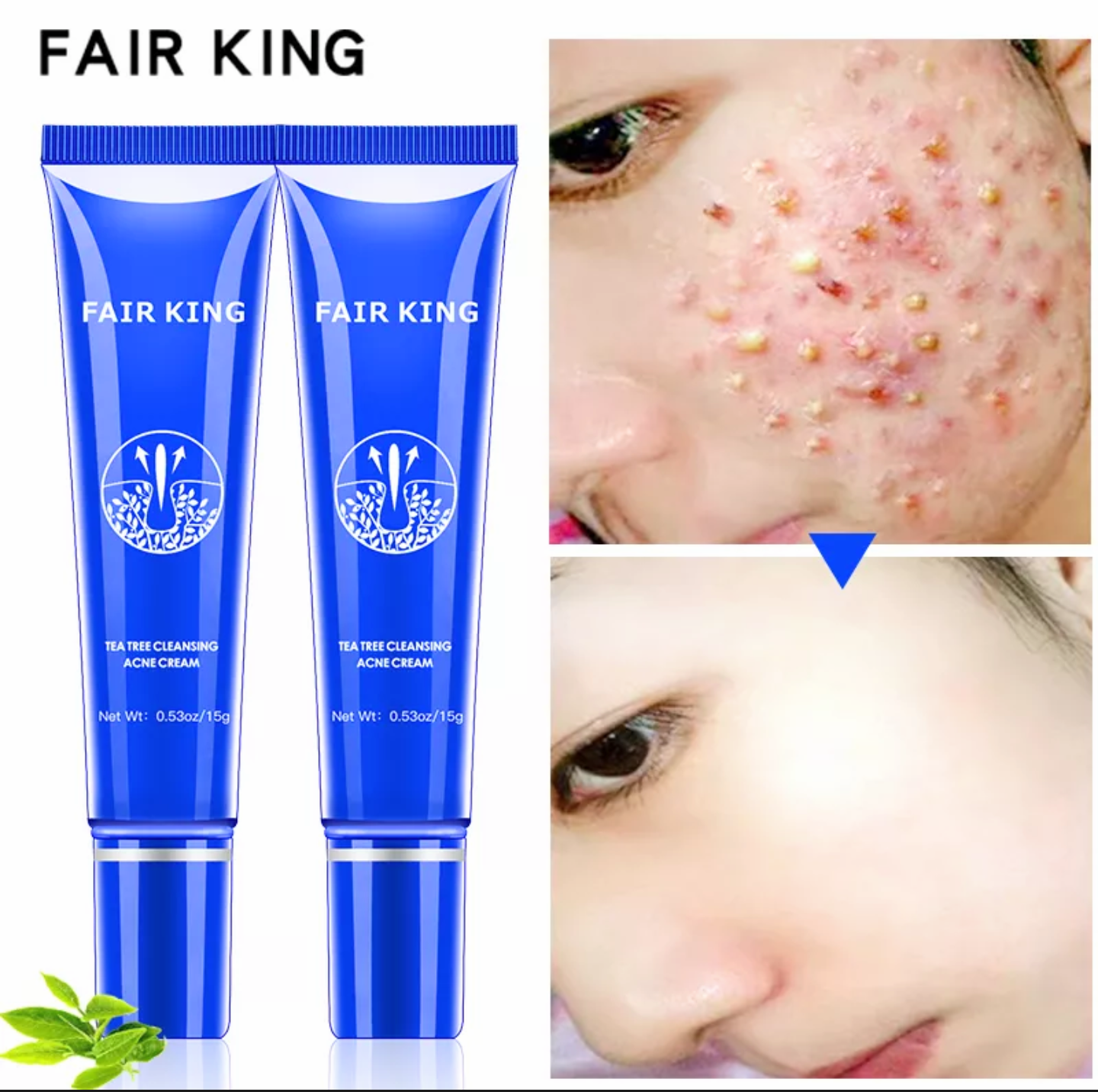 1 HỘP KEM TRỊ LOẠI BỎ MỤN LÀM MỜ CÁC VẾT SẸO TÀN NHANG DƯỠNG DA LÀM TRẮNG DA MẶT CAM KẾT HIỆU QUẢ HÀNG LOẠI TỐT