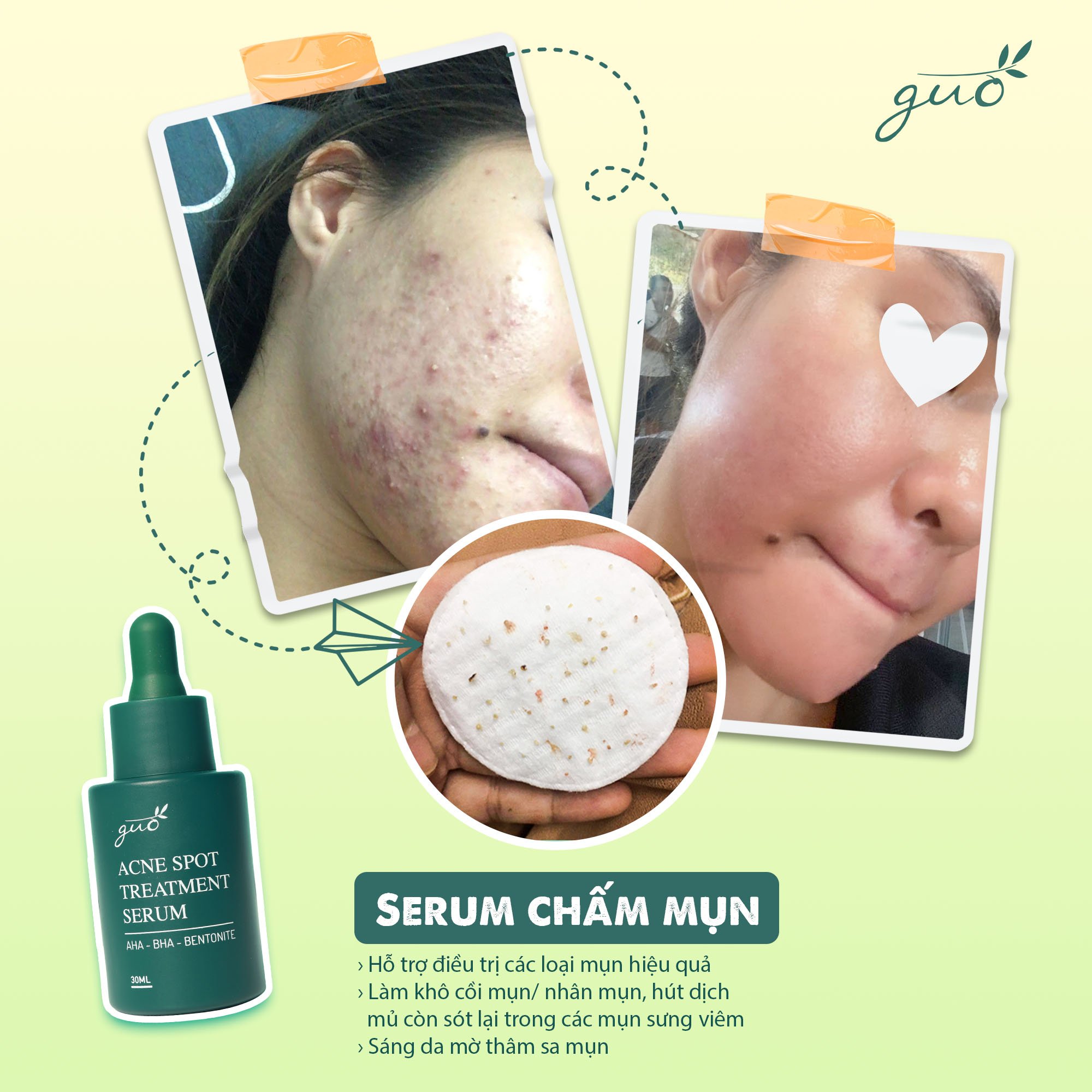 Tinh chất Serum Sạch Mụn Mờ Thâm Gom Mụn cho bà bầu GUO 30ml