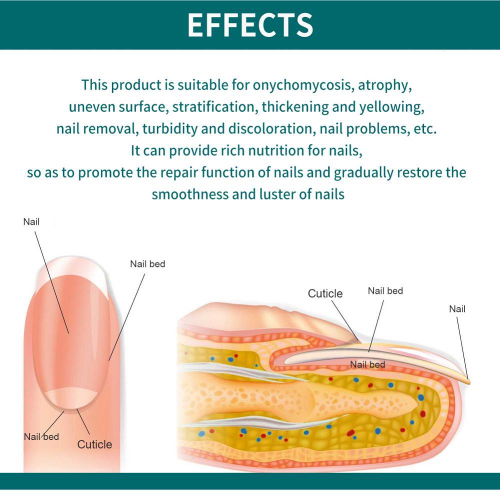 Nấm móng tay sửa chữa sơn, 5ml, sơn dinh dưỡng móng tay, dày, điều hòa, nâng móng tay, mịn, chất lỏng, chăm sóc bàn chân nuôi dưỡng
