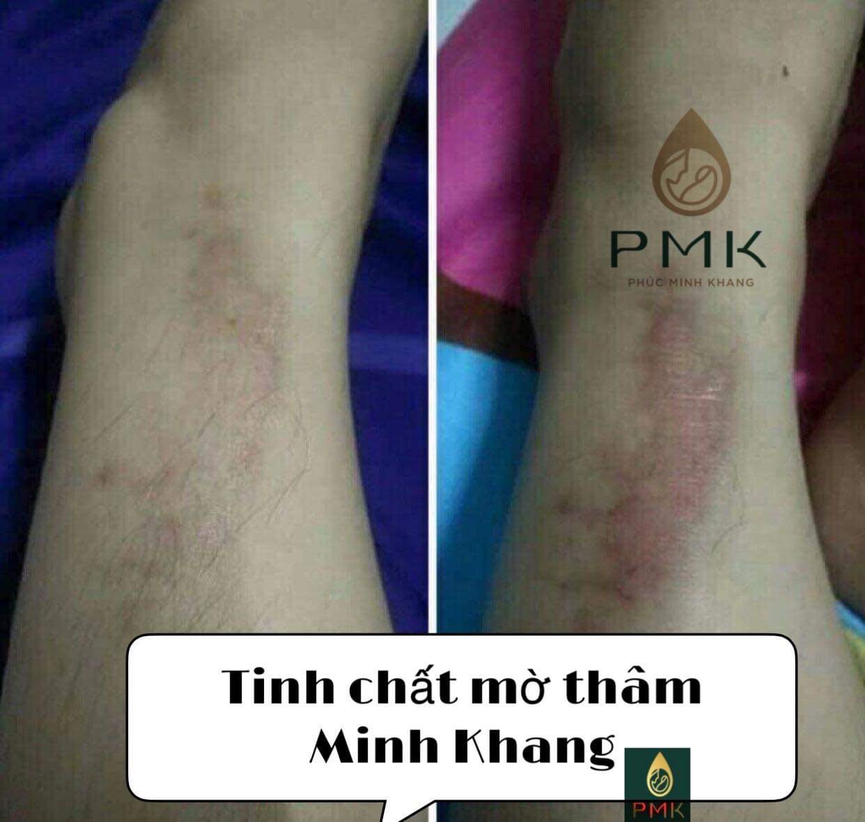 Combo 2 lọ Tinh Chất Mờ Thâm Minh Khang