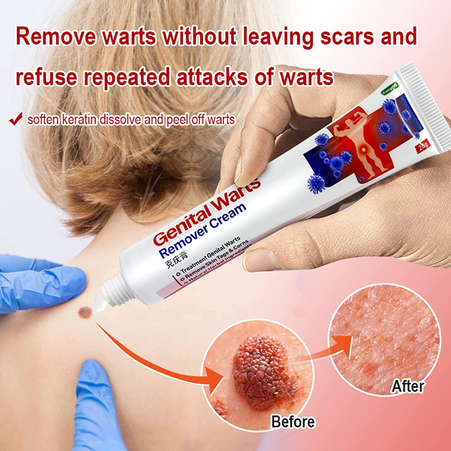 20g Thuốc mỡ chống mụn cóc sinh dục Thảo dược tự nhiên Nhẹ nhàng không gây kích ứng Primer Skin Tag Góc làm giảm sự khó chịu