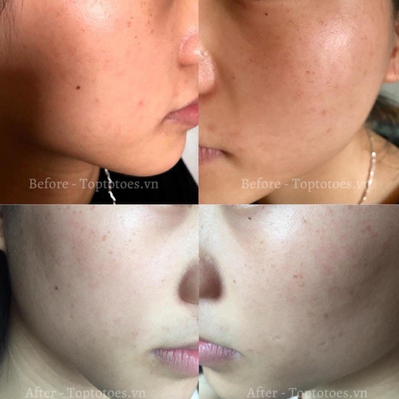 Hộp 10 lọ Serum Teana Super Peptides ASAP dưỡng trắng, mờ thâm